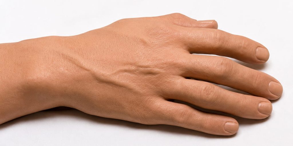 Prosthetic Hand